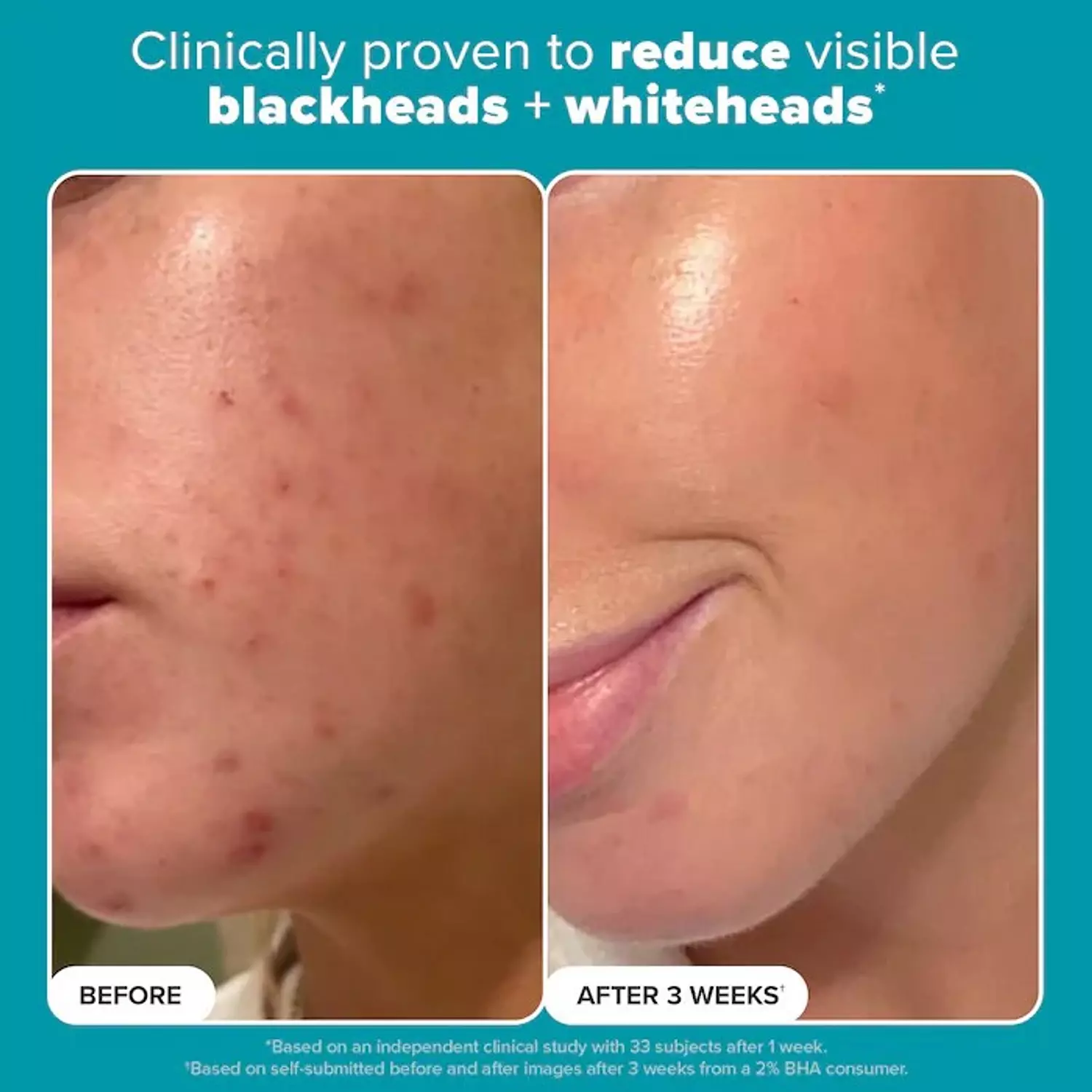 Paula's Choice  Skin Perfecting 2% BHA Exfoliating Toner for Clear Skin  2