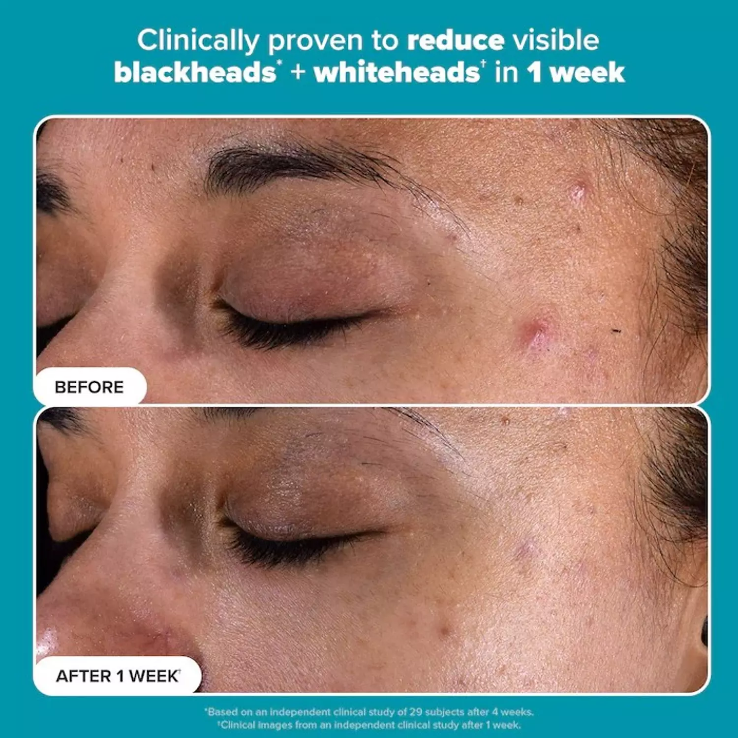 Paula's Choice  Skin Perfecting 2% BHA Exfoliating Toner for Clear Skin  1